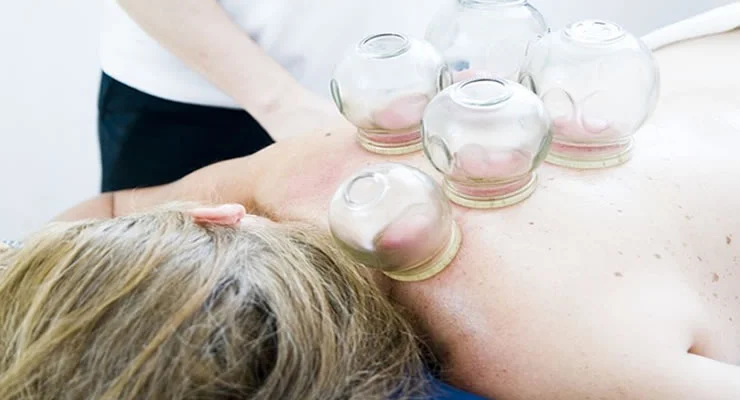 Massagem com Ventosas: Terapia Antiga para Alívio da Dor e Tensão